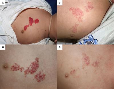 Case report: Deterioration of infantile hemangioma related to oral or nebulized administration of β2-AR agonist: Three cases reports